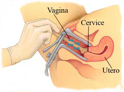 Pap Test a volla