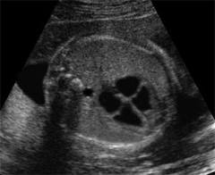Ecocardiografia fetale a Napoli