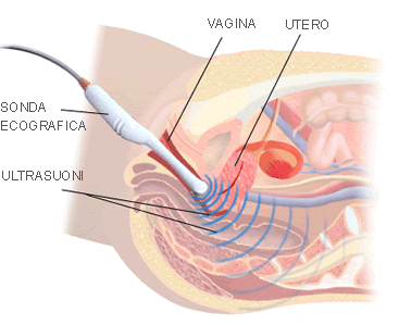 Ecografia Transvaginale a caserta